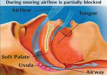 Load image into Gallery viewer, Magical and adaptable Anti Snore Nose Device For Men Women